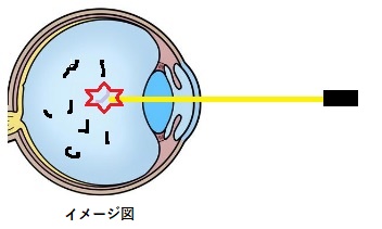 レーザー治療イメージ図